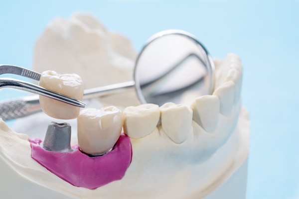 How Dental Crowns Are Bonded To A Tooth