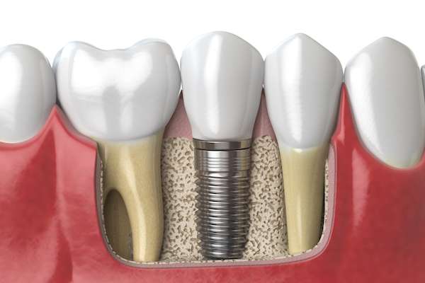 Dental Implants for Replacing Missing Teeth from Brentwood Dental Group in Los Angeles, CA