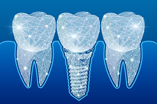 Preventing Complications After Getting Dental Implants from Brentwood Dental Group in Los Angeles, CA