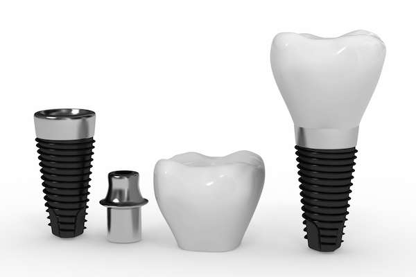 What Are the Parts of Dental Implants from Brentwood Dental Group in Los Angeles, CA