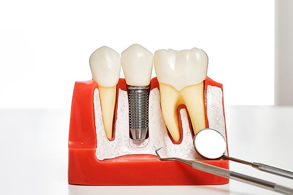 Your Guide to Different Kinds of Dental Implants from Brentwood Dental Group in Los Angeles, CA